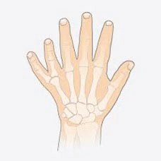 Illustrated example of Polydactyly, with an extra, complete digit