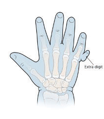 Illustrated example of Polydactyly, with an extra, split digit
