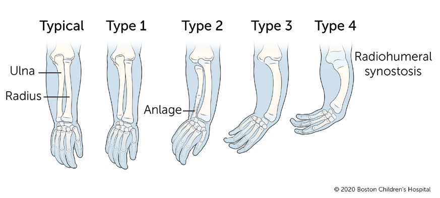 The different types of Ulna Longitudinal Deficiency