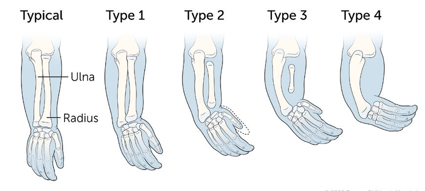 Different types of Radial longitudinal deficiency