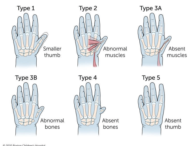 Types of Thumb hypoplasia and aplasia
