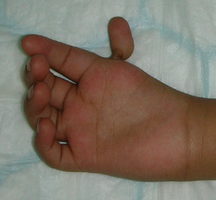 Thumb hypoplasia and aplasia