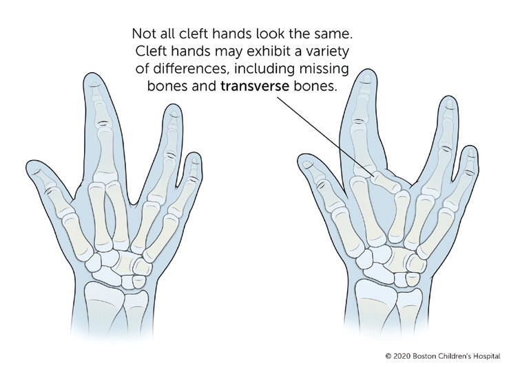 Illustrated example of different cleft hands