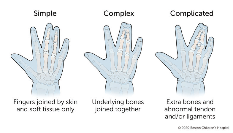 Types of Syndactyly