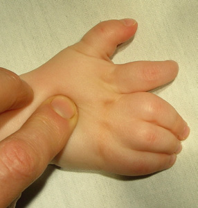 Post-operation Syndactyly separation