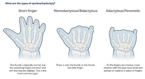 There are different types of Symbrachydactyly. Short finger, where the thumb is normal by the remaining fingers are short and stiff and may be webbed. This is the most common type. Monodactylous/Bidactylous, where there is only the thumb or thumb and little finger. Adactylous/Peromelic, where all the fingers are missing.