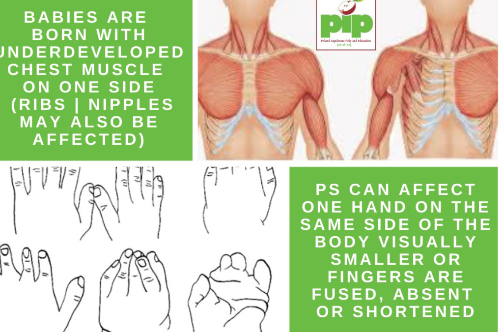 Babies are born with underdeveloped chest muscle on one side (ribs/nipples may also be affected). PS can affect one hand on the same side of the body visually smaller or fingers are fused absent or shortened